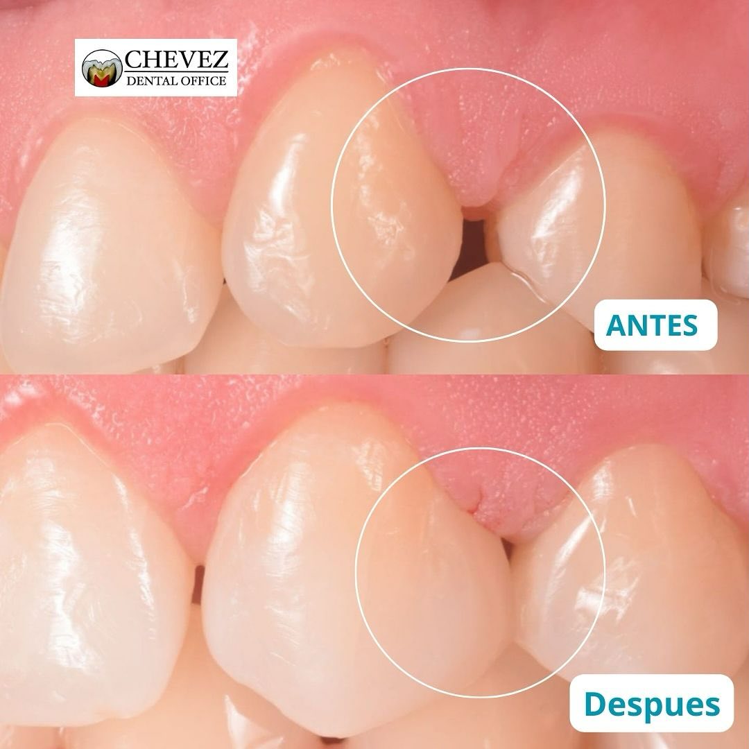 Cierre de diastema anterior