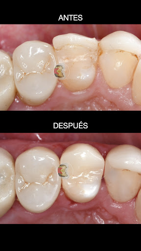 Desgaste posterior por apretamiento