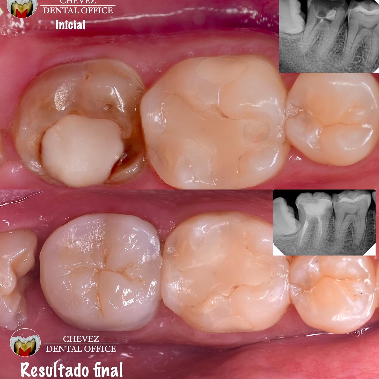 Endodoncia e Incrustación
