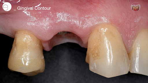 Contorno Gingival para Implante