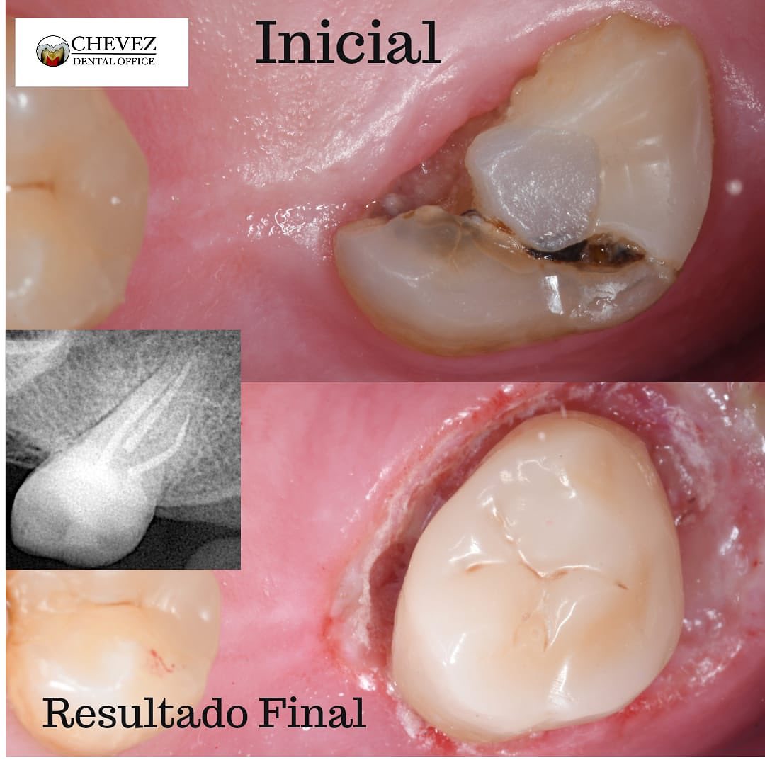 Incrustación Cerámica In-house